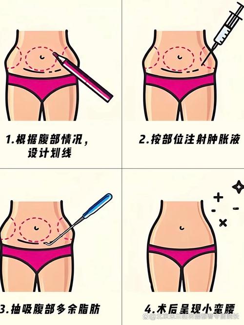 吸脂减肥与体型雕塑术_吸脂塑形_面部吸脂瘦脸会反弹吗