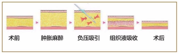 面部吸脂瘦脸会反弹吗_吸脂塑形_吸脂减肥与体型雕塑术