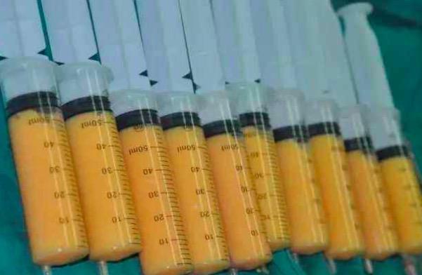 吸脂减肥后会不会反弹_吸脂手术禁忌部位_做完臀部吸脂怀孕后会反弹吗